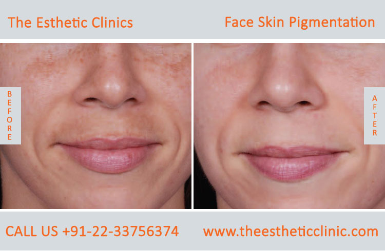 Face Skin Pigmentation Laser Treatment before after photos in mumbai india (5)